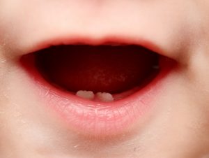 Tooth Decay from baby Bottles