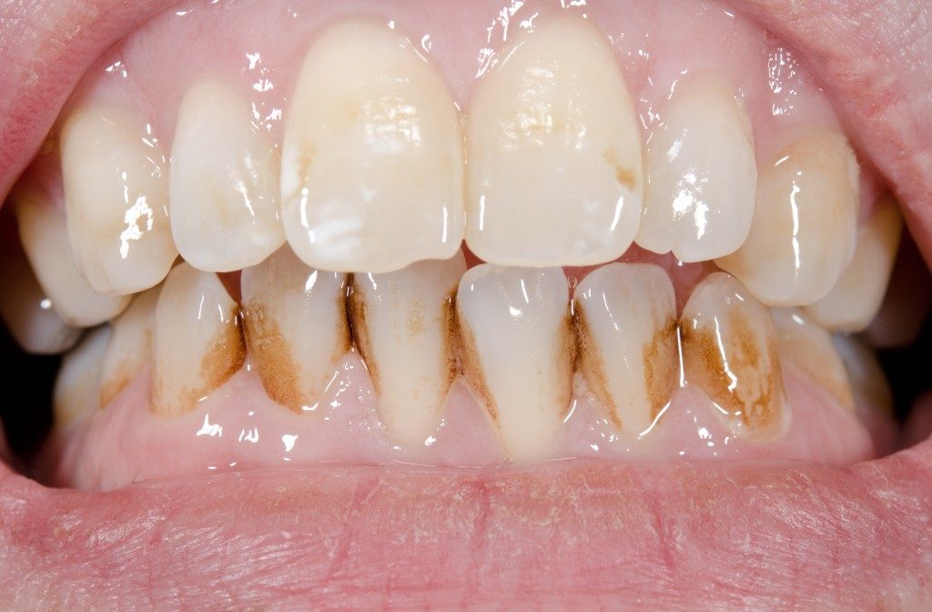 Teeth with brown stains