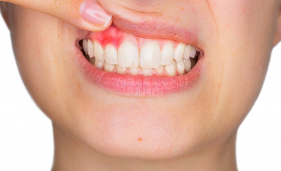 Woman showing her inflamed gum