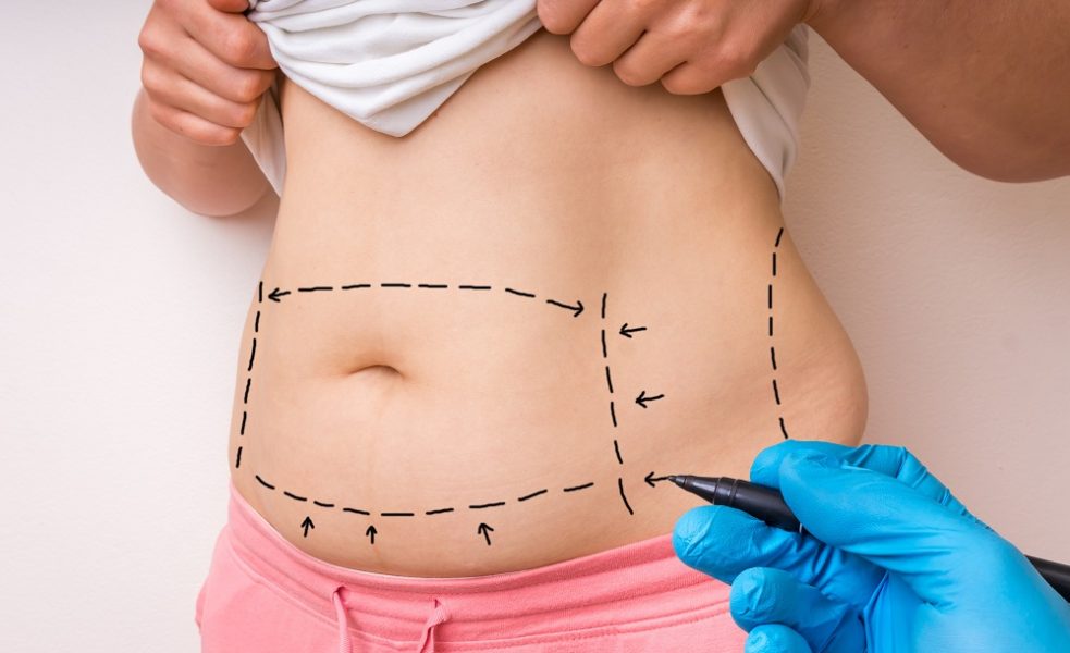 liposuction process