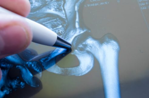 Hip replacement x-ray