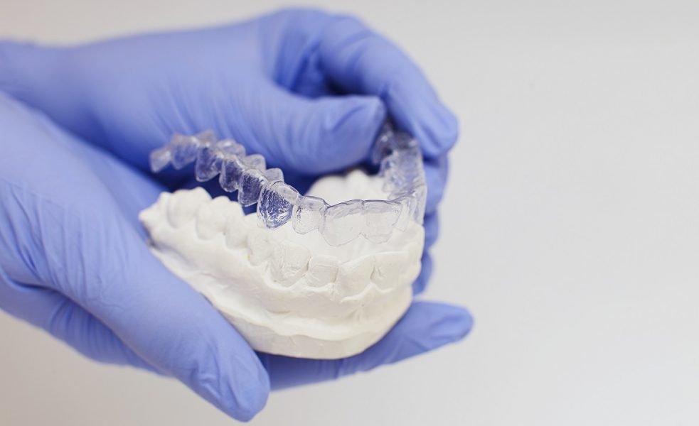 sample clear braces