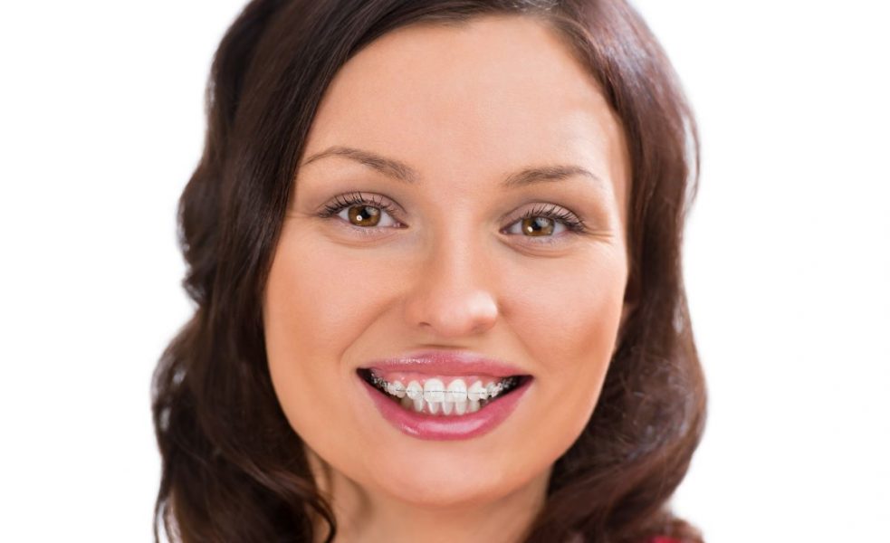 woman with clear braces
