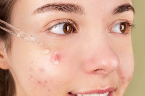 treating-acne