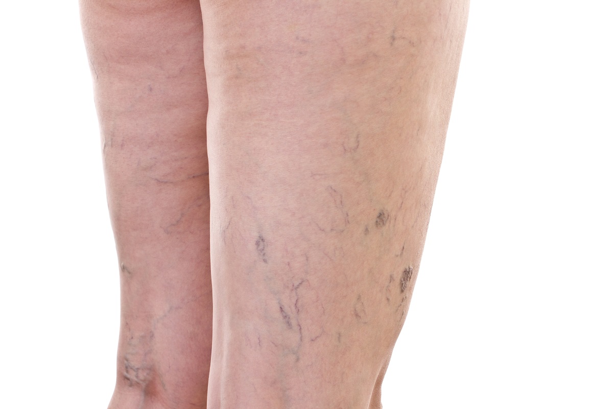 An image of legs with varicose veins