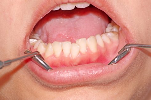 Dental crowding lower jaw