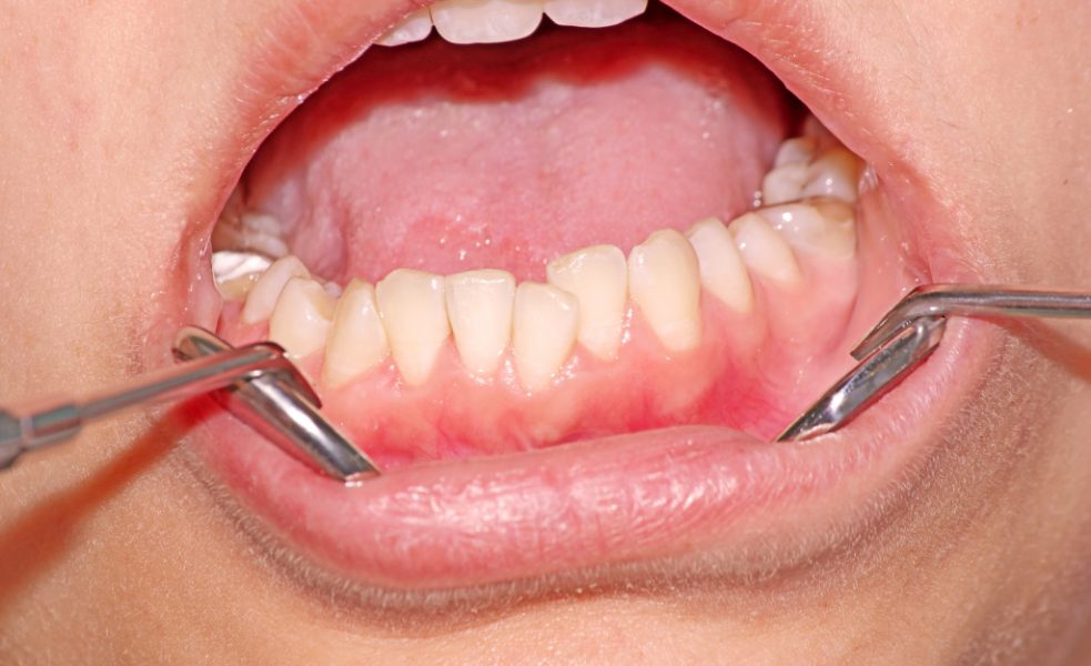 Dental crowding lower jaw
